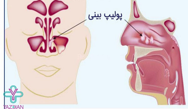 پولیپ حنجره